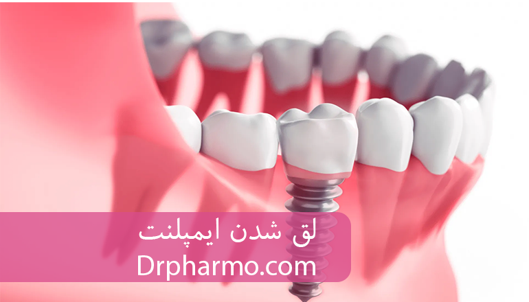 چرا ایمپلنت لق میشود؟