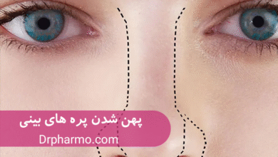 علت پهن شدن پره های بینی بعد از عمل